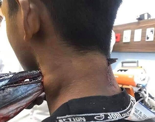 Peixe-agulha perfura pescoço de jovem na Indonésia