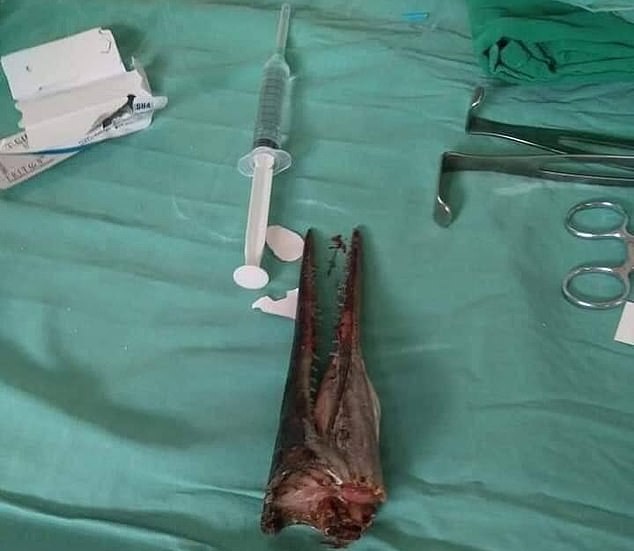 Peixe-agulha perfura pescoço de jovem na Indonésia